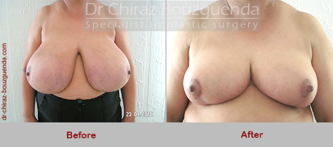 breast reduction before after