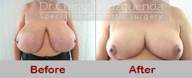 breast reduction before after