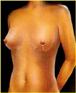 breast reduction surgery tunisia