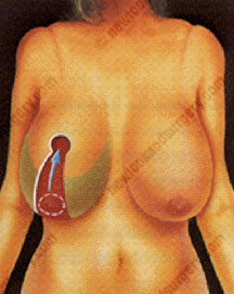 cost breast reduction tunisia