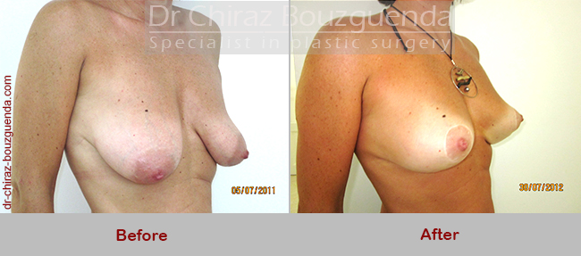 breast lift before after photos