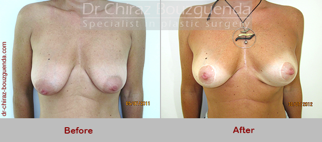 breast lift before after