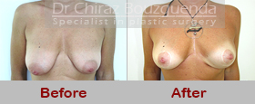 breast lift before after