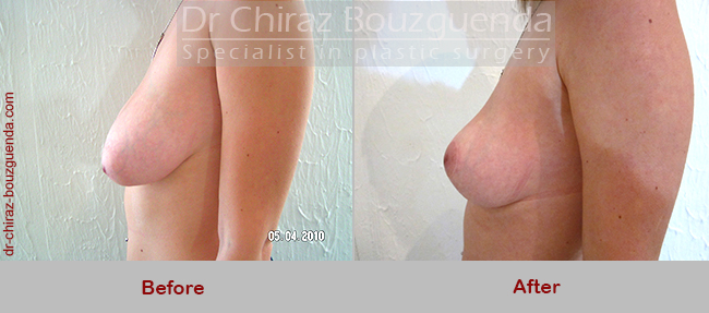 breast lift before and after