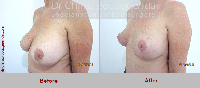 breast lift before after