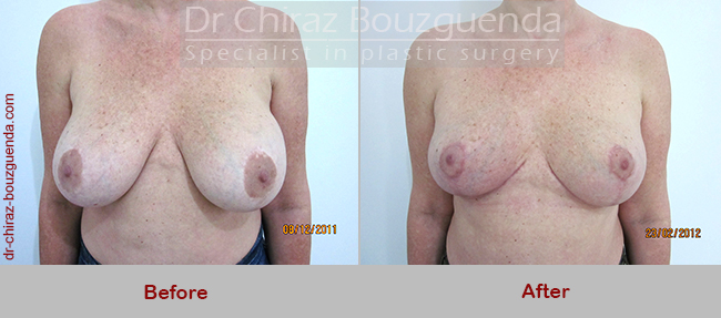 breast lift before and after