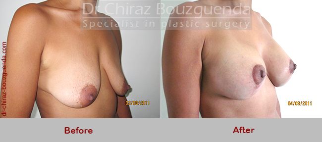 breast lift with implants before and after