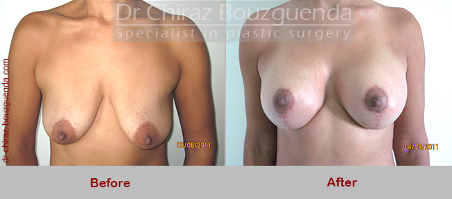 breast lift with implants before after