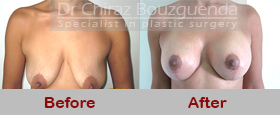 breast lift with implants before after