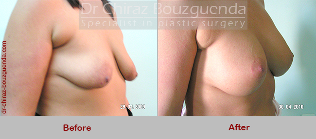 breast lift with implants before and after photos