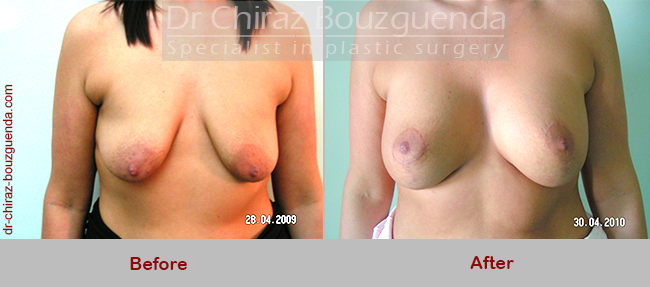 breast lift with implants before after photos