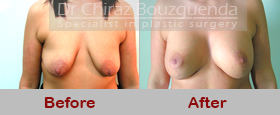 breast lift with implants before and after