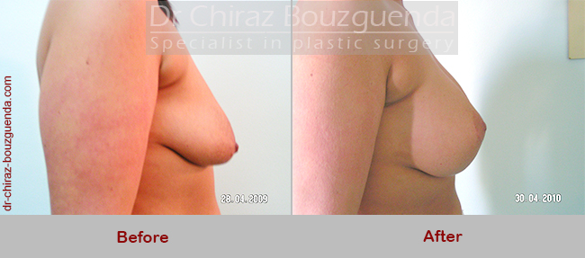 breast lift with implants before after pictures