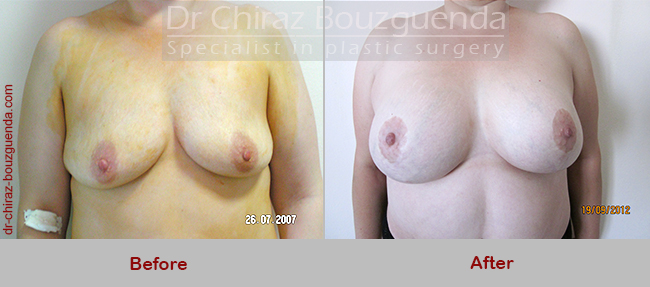 breast lift before and after