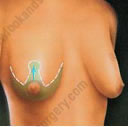 breast lift tunisia