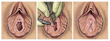 hymen-surgery-overseas-tunisia