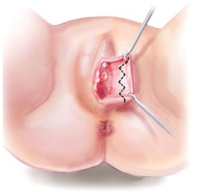 labiaplasty-technique-abroad-tunisia