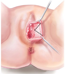 labiaplasty-procedure-abroad-tunisia