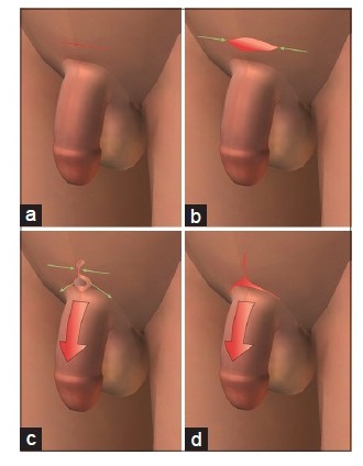 penis-elongation-abroad-tunisia