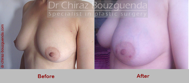 breast fat transfer before and after