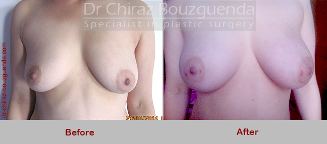 breast fat transfer before after photos