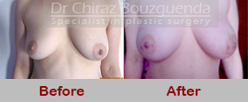 breast fat transfer before after