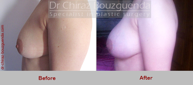 breast fat transfer before after pictures