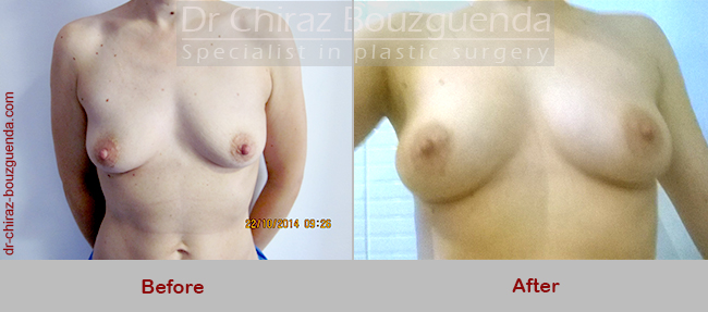 breast augmentation fat transfer before after photos