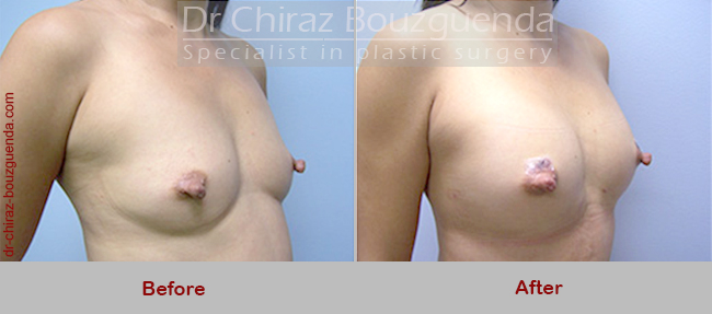 breast fat grafting before after pics