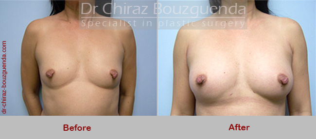 breast augmentation fat transfer before after