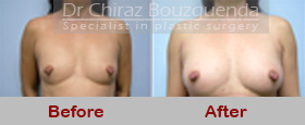 breast augmentation fat grafting before after pictures