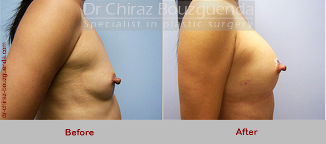 breast augmentation fat grafting abroad before after photos