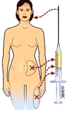 facial fat transfer abroad