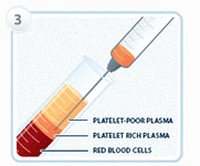 cost prp abroad