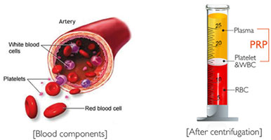 platelet rich plasma abroad