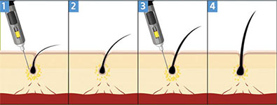 prp hair treatment abroad
